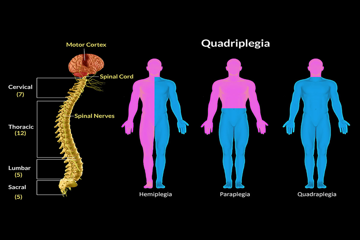 new research in quadriplegia